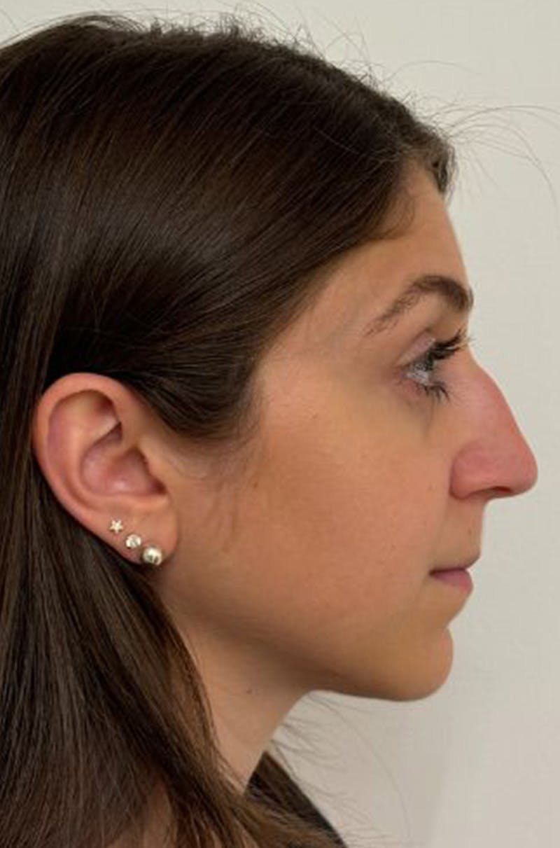 Rhinoplasty Before & After Gallery - Patient 389412 - Image 5