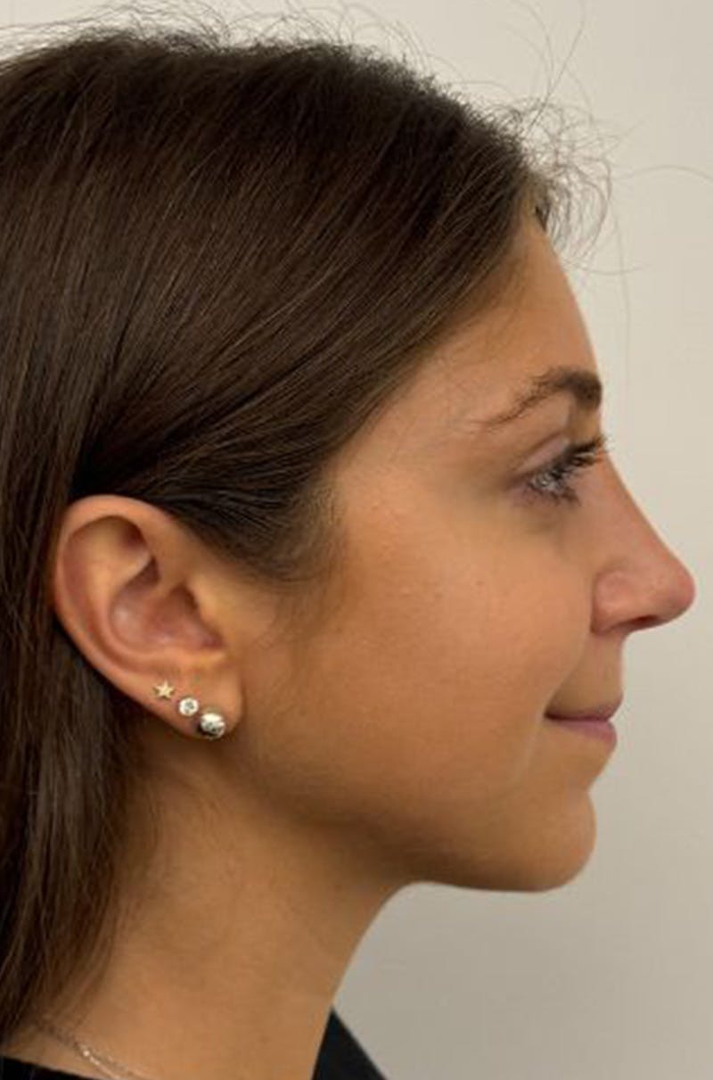Rhinoplasty Before & After Gallery - Patient 389412 - Image 6