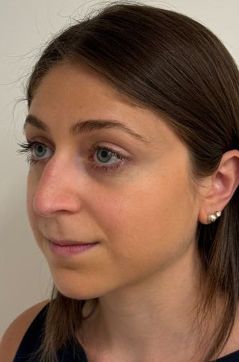 Rhinoplasty Before & After Gallery - Patient 389412 - Image 7
