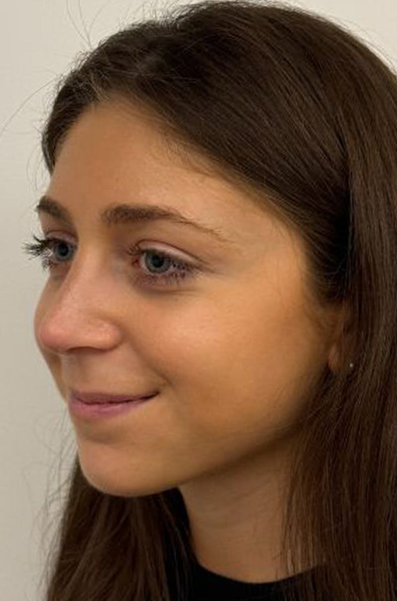 Rhinoplasty Before & After Gallery - Patient 389412 - Image 8