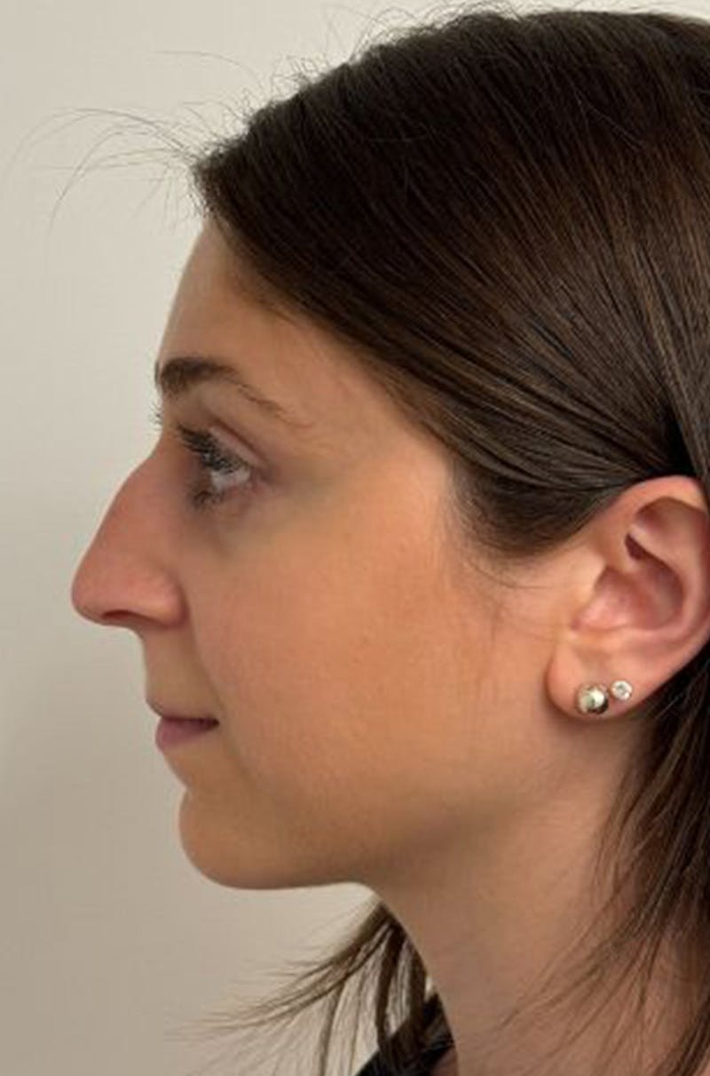 Rhinoplasty Before & After Gallery - Patient 389412 - Image 9