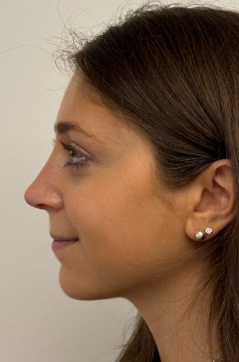 Rhinoplasty Before & After Gallery - Patient 389412 - Image 10