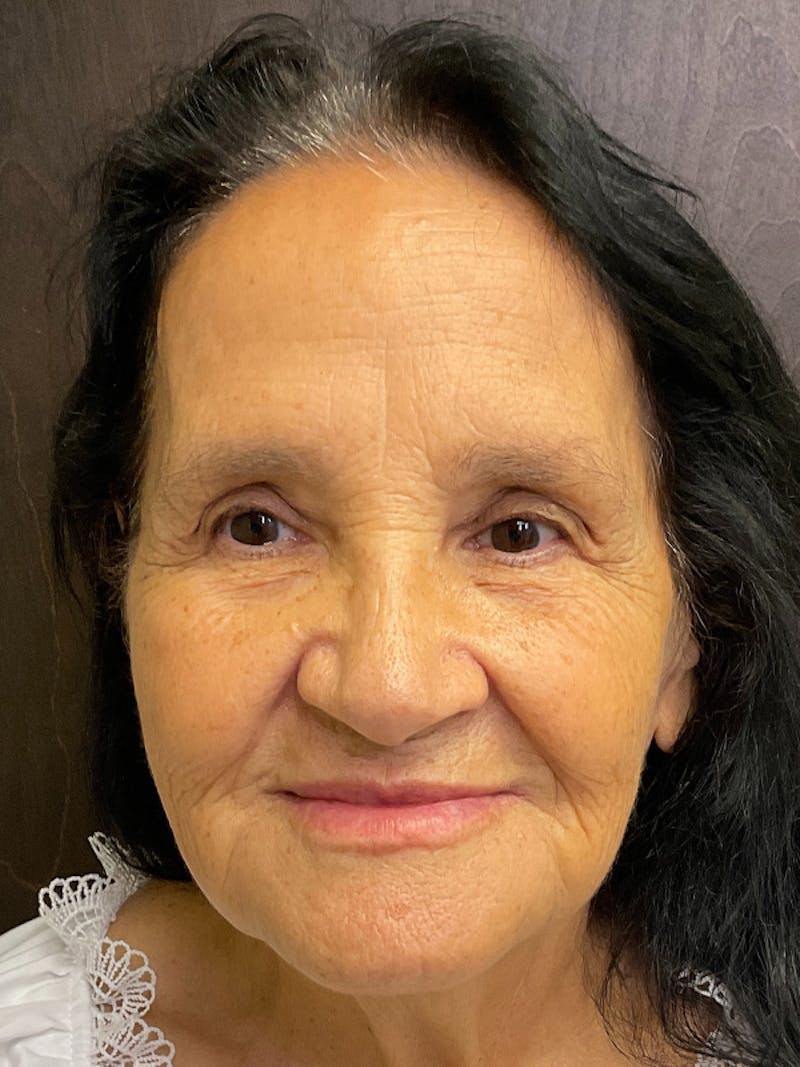 Full Face Filler Before & After Gallery - Patient 131838945 - Image 2