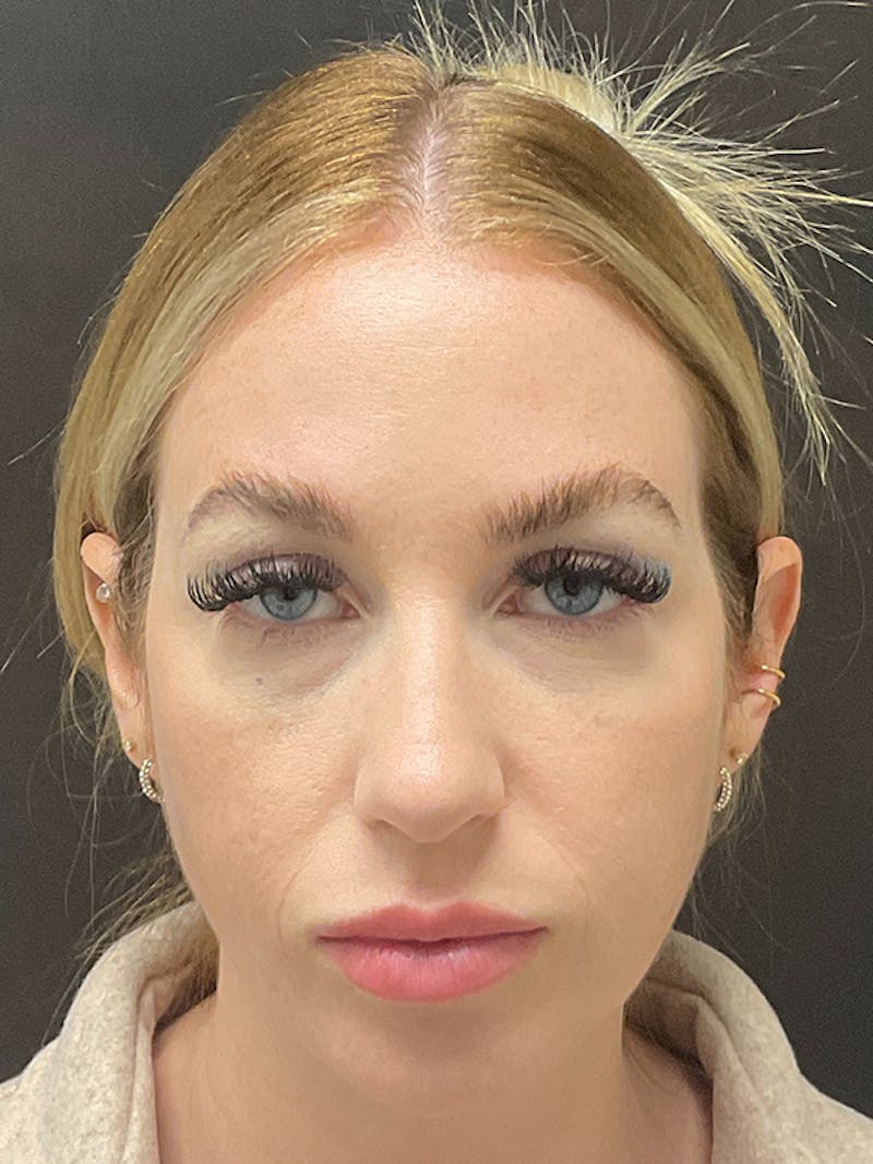 Full Face Filler Before & After Gallery - Patient 131838946 - Image 1