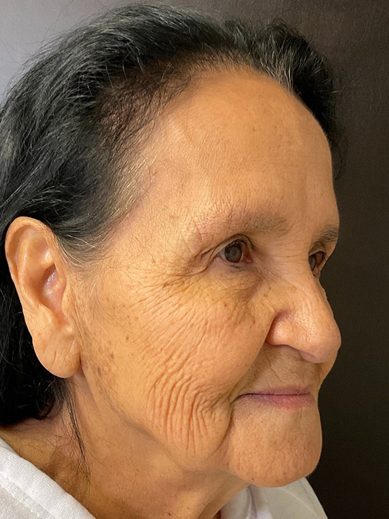 Full Face Filler Before & After Gallery - Patient 131838945 - Image 3