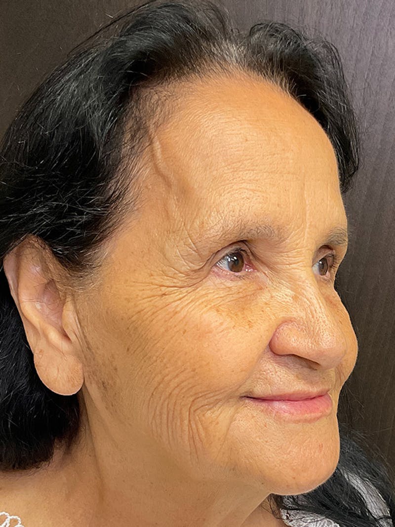 Full Face Filler Before & After Gallery - Patient 131838945 - Image 4