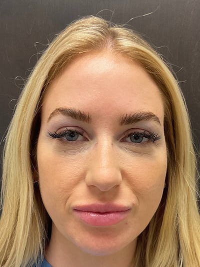 Full Face Filler Before & After Gallery - Patient 131838946 - Image 2