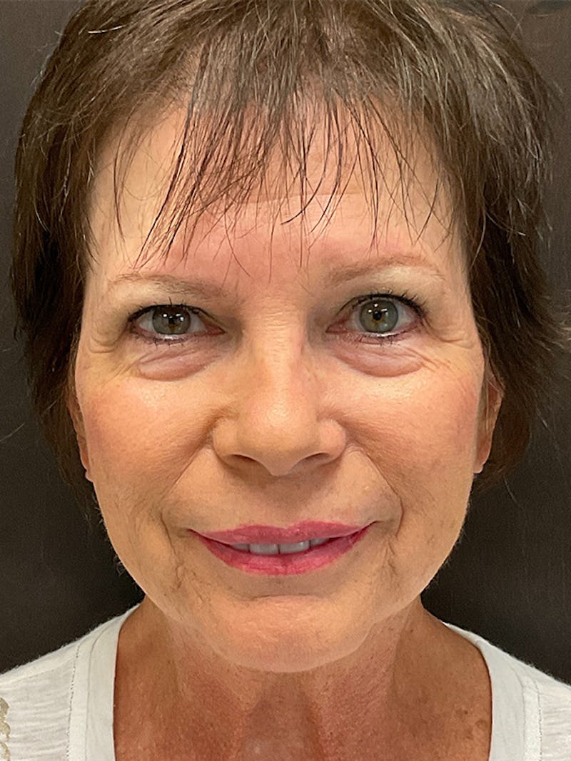 Full Face Filler Gallery - Patient 131838947 - Image 1