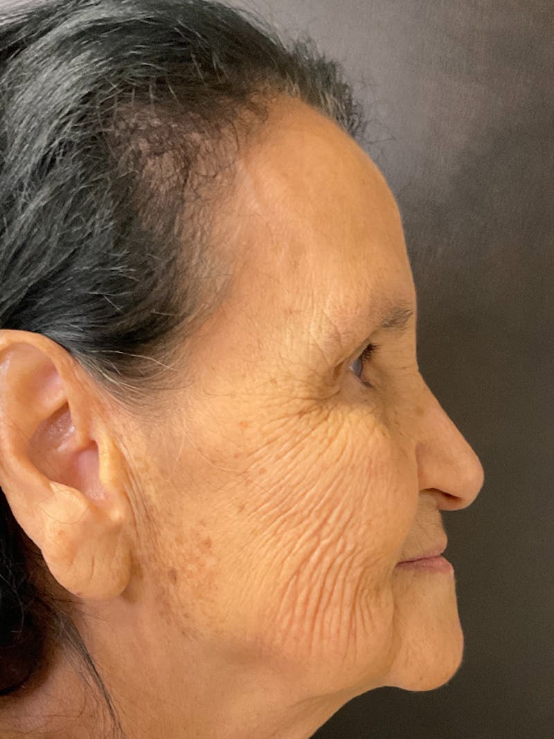 Full Face Filler Gallery - Patient 131838945 - Image 5