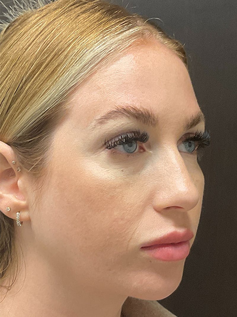 Full Face Filler Before & After Gallery - Patient 131838946 - Image 3