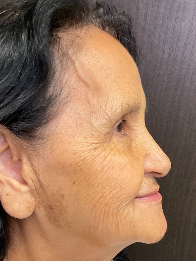 Full Face Filler Before & After Gallery - Patient 131838945 - Image 6