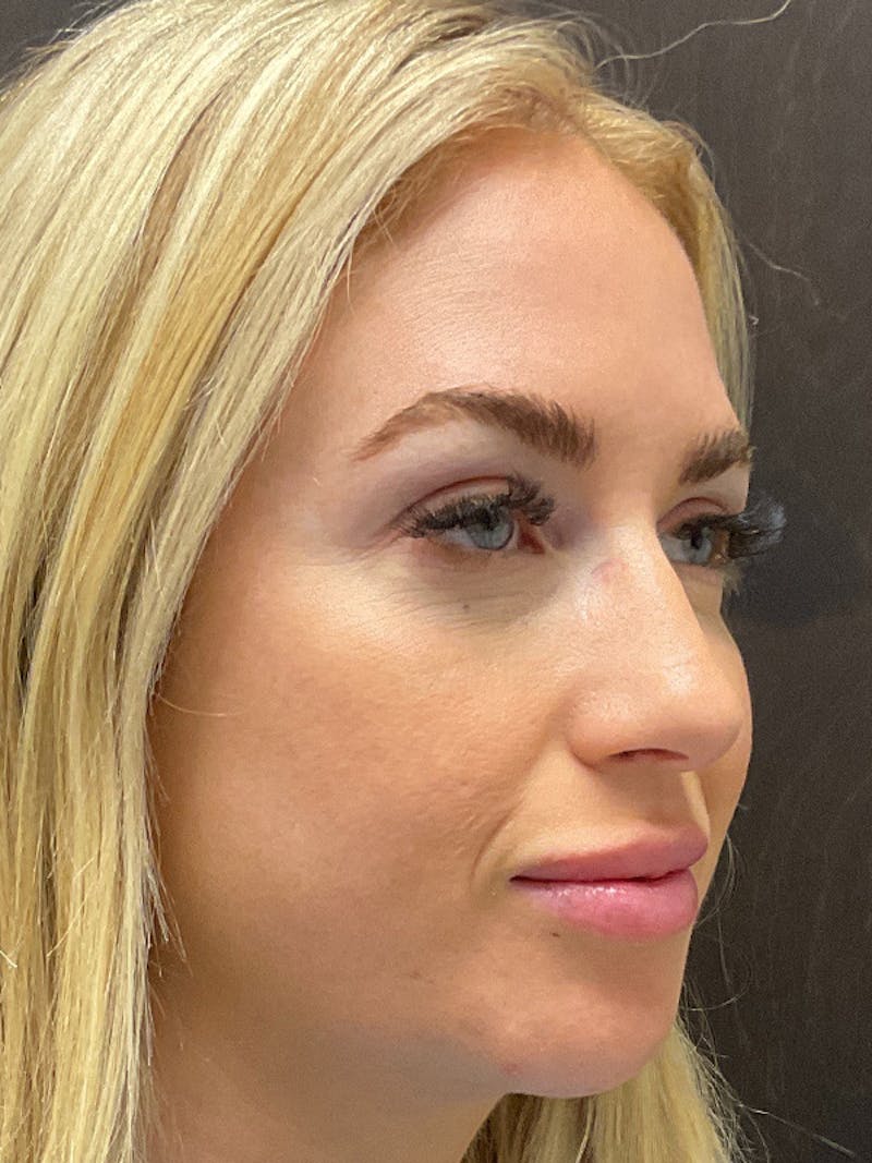 Full Face Filler Gallery - Patient 131838946 - Image 4