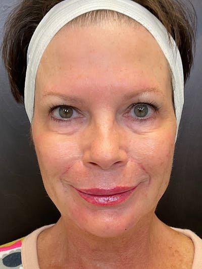 Full Face Filler Before & After Gallery - Patient 131838947 - Image 2