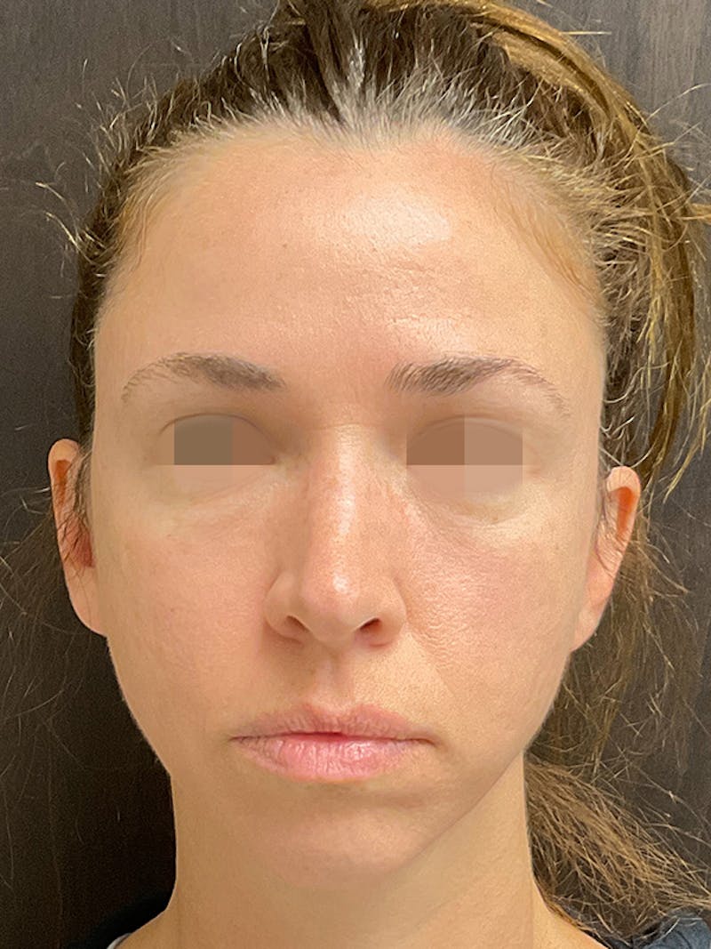 Full Face Filler Before & After Gallery - Patient 131838948 - Image 1