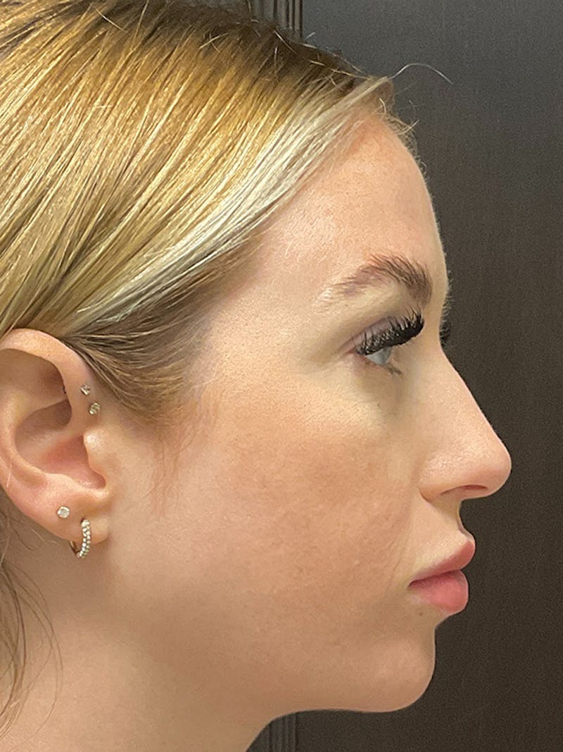 Full Face Filler Before & After Gallery - Patient 131838946 - Image 5