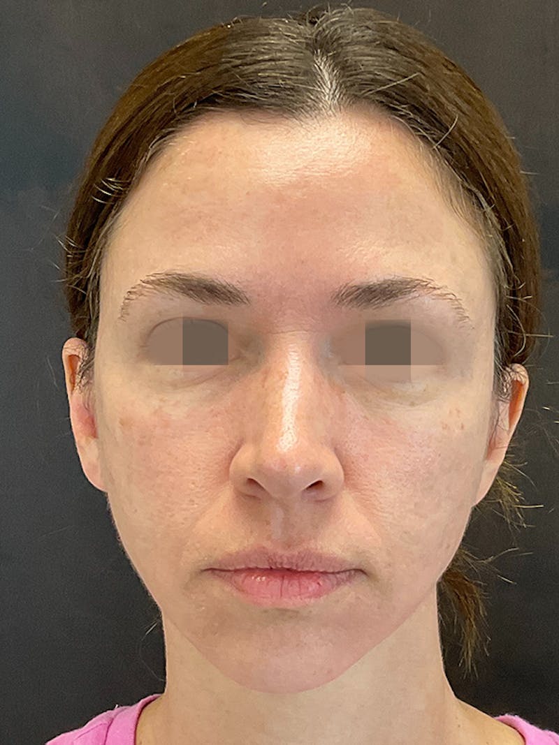Full Face Filler Gallery - Patient 131838948 - Image 2