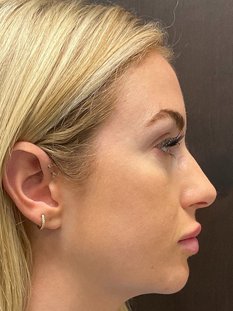 Full Face Filler Before & After Gallery - Patient 131838946 - Image 6