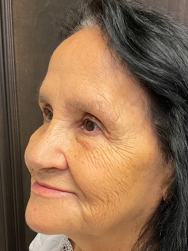 Full Face Filler Before & After Gallery - Patient 131838945 - Image 8
