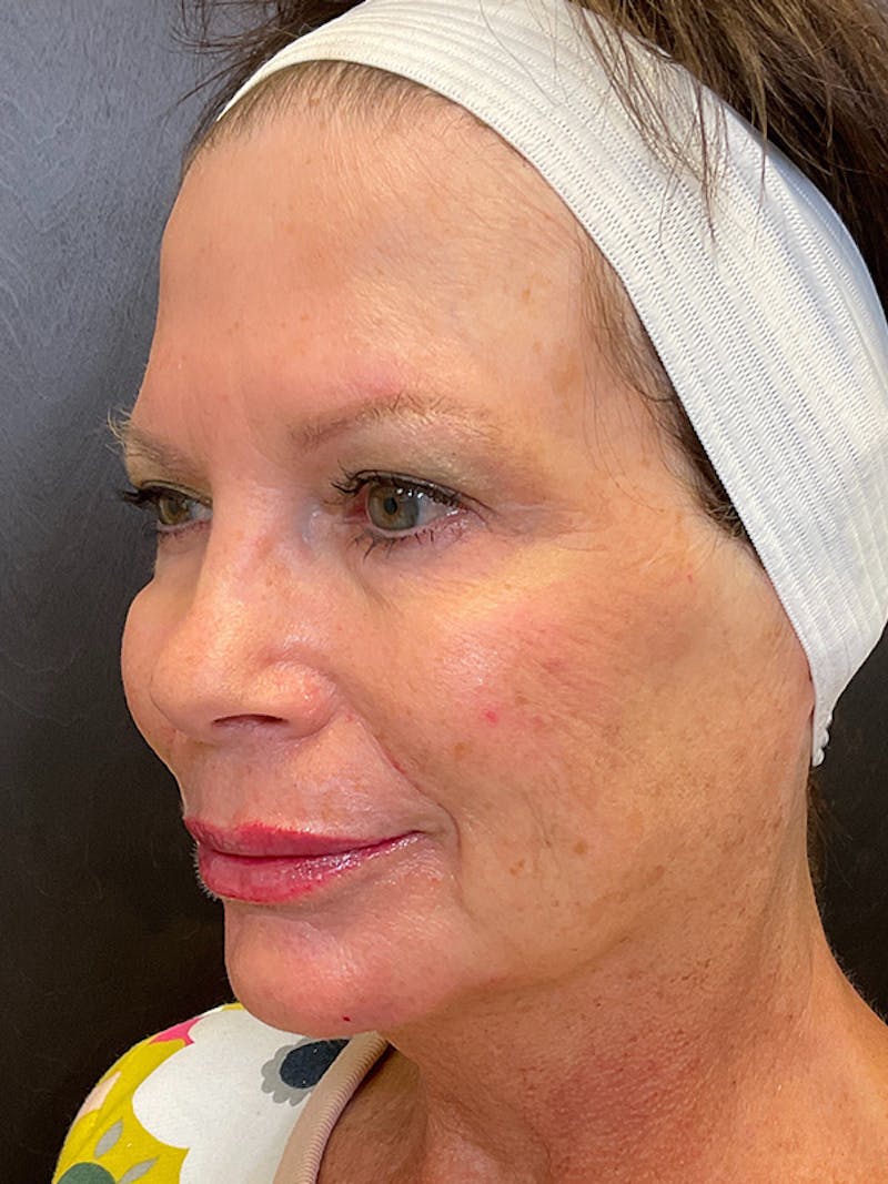 Full Face Filler Before & After Gallery - Patient 131838947 - Image 4