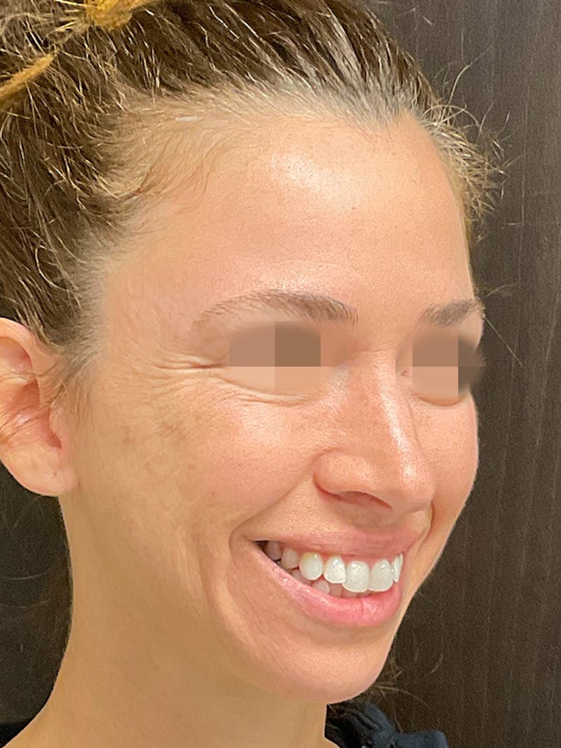 Full Face Filler Gallery - Patient 131838948 - Image 3