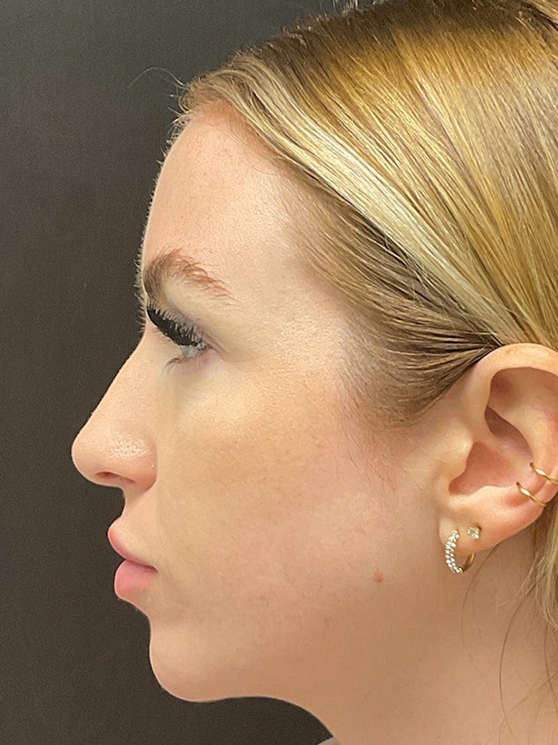 Full Face Filler Before & After Gallery - Patient 131838946 - Image 7