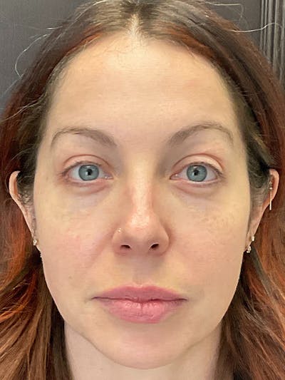 Full Face Filler Before & After Gallery - Patient 131838949 - Image 1