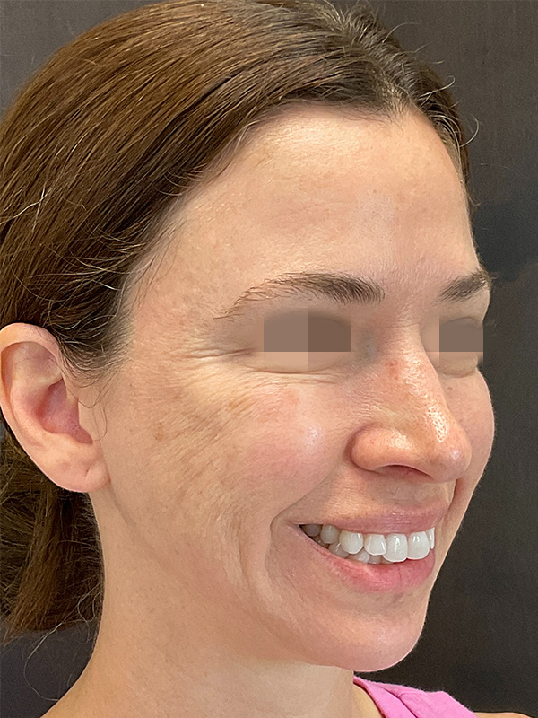 Patient 131838948 Full Face Filler Before & After Photos Highwater