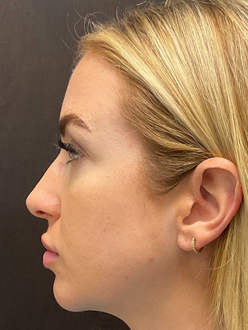 Full Face Filler Before & After Gallery - Patient 131838946 - Image 8