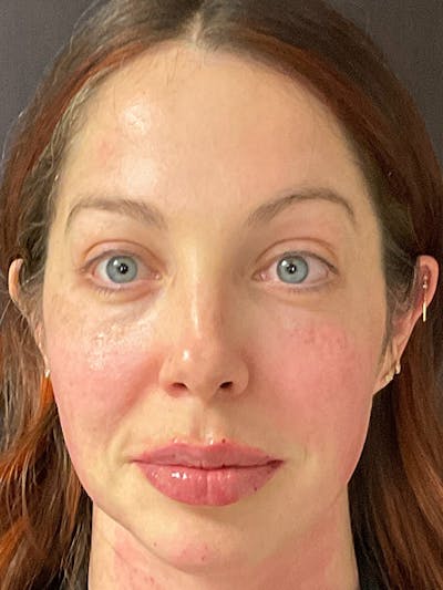 Full Face Filler Before & After Gallery - Patient 131838949 - Image 2