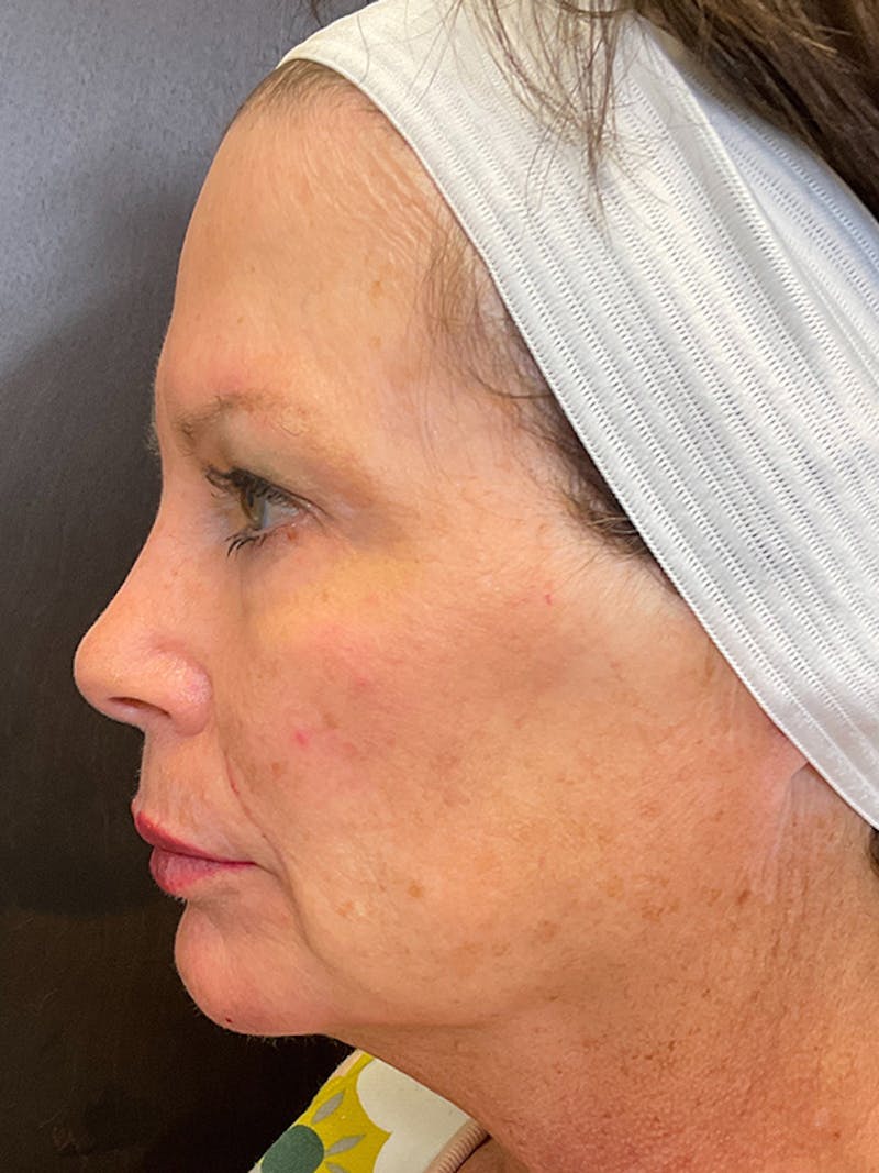Full Face Filler Before & After Gallery - Patient 131838947 - Image 6