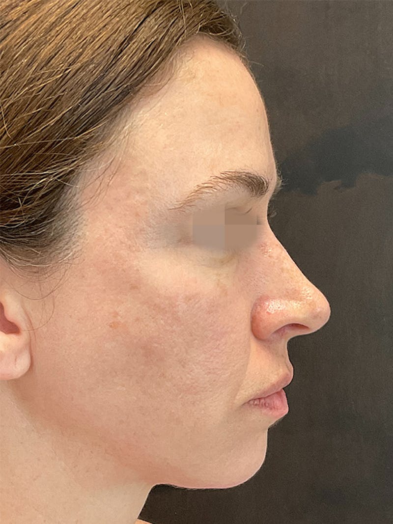 Full Face Filler Before & After Gallery - Patient 131838948 - Image 5