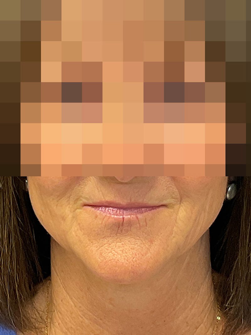 Full Face Filler Gallery - Patient 131838950 - Image 1