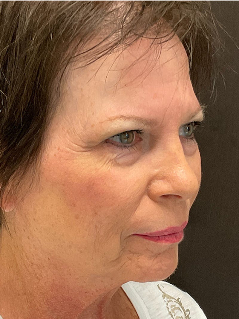 Full Face Filler Before & After Gallery - Patient 131838947 - Image 7