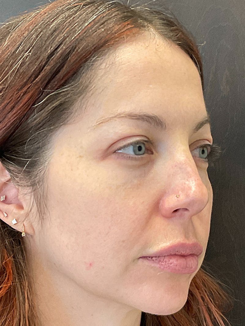 Full Face Filler Gallery - Patient 131838949 - Image 3