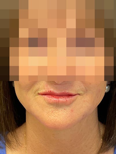 Full Face Filler Gallery - Patient 131838950 - Image 2