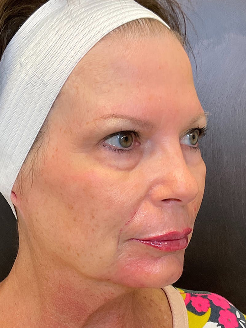 Full Face Filler Before & After Gallery - Patient 131838947 - Image 8