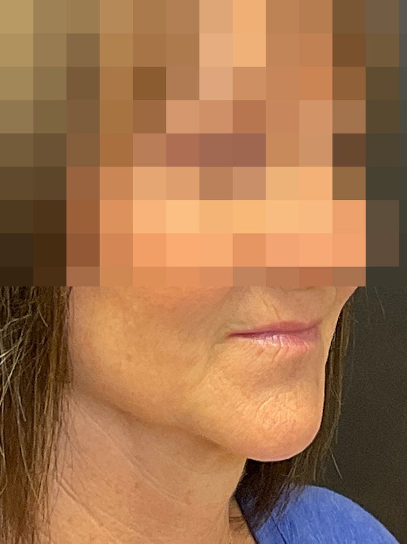 Full Face Filler Before & After Gallery - Patient 131838950 - Image 3