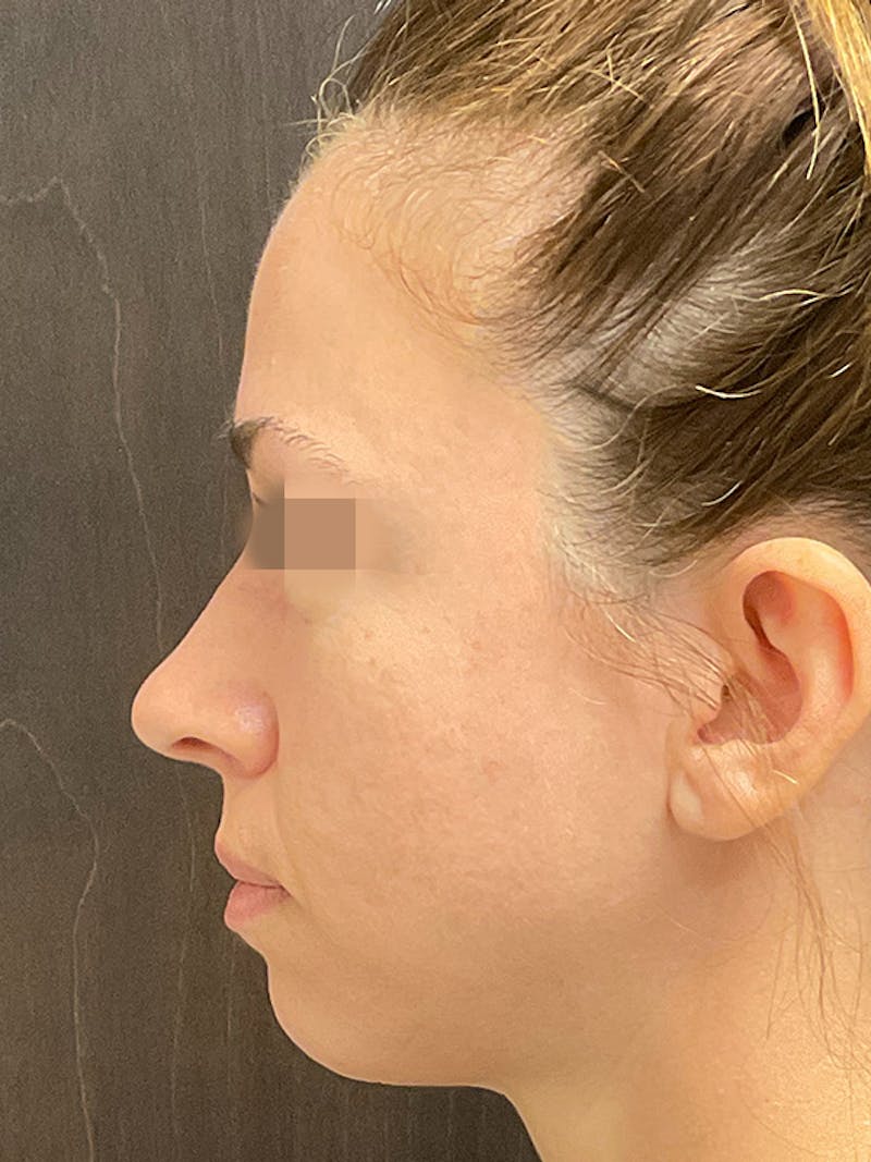 Full Face Filler Before & After Gallery - Patient 131838948 - Image 7