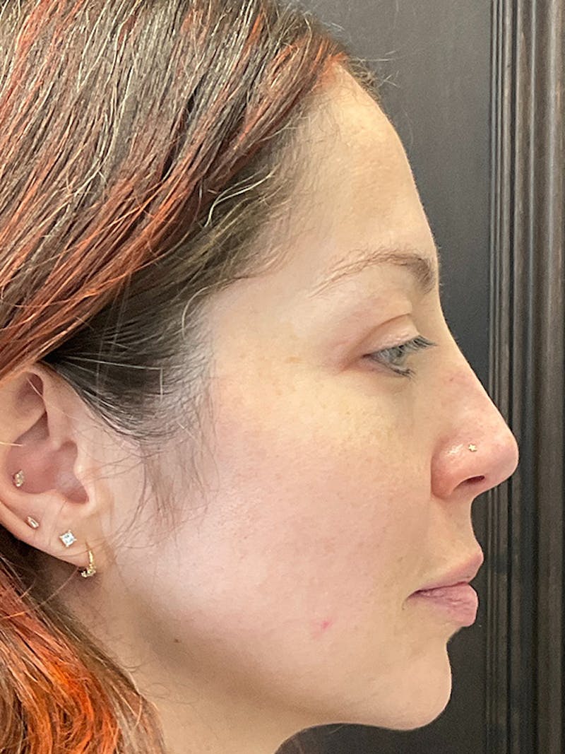Full Face Filler Before & After Gallery - Patient 131838949 - Image 5