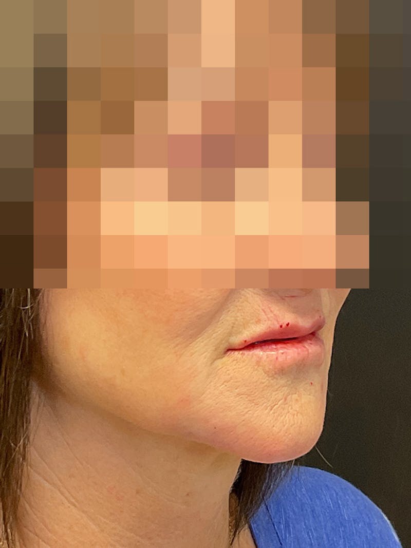 Full Face Filler Before & After Gallery - Patient 131838950 - Image 4