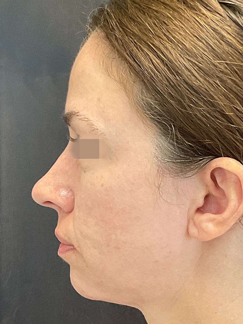 Full Face Filler Before & After Gallery - Patient 131838948 - Image 8
