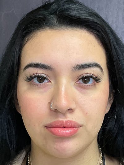 Full Face Filler Before & After Gallery - Patient 131838951 - Image 2