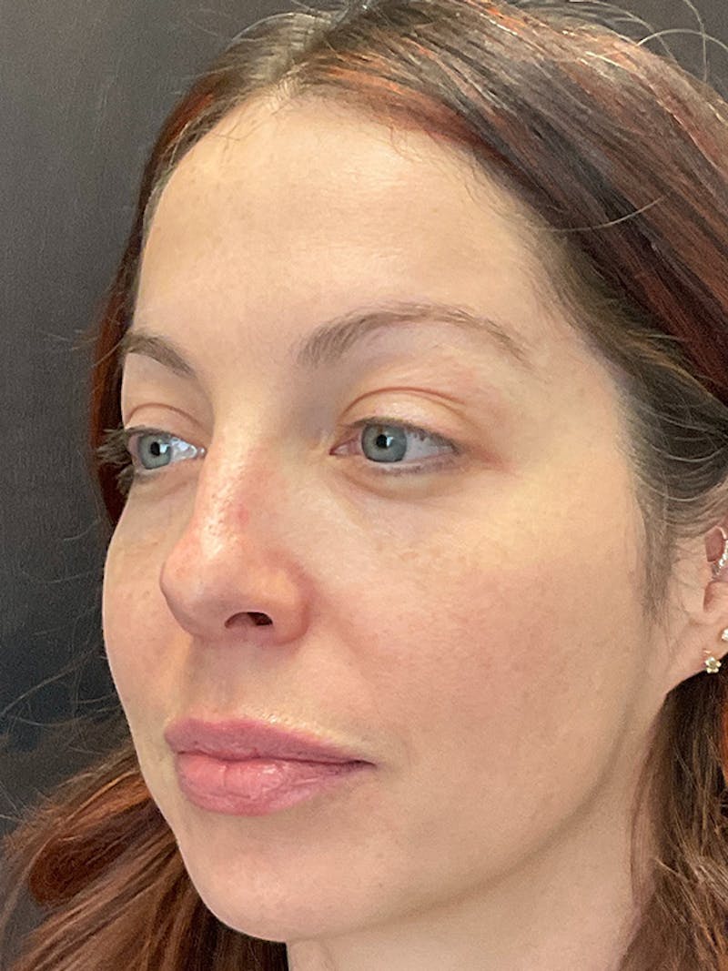 Full Face Filler Before & After Gallery - Patient 131838949 - Image 7