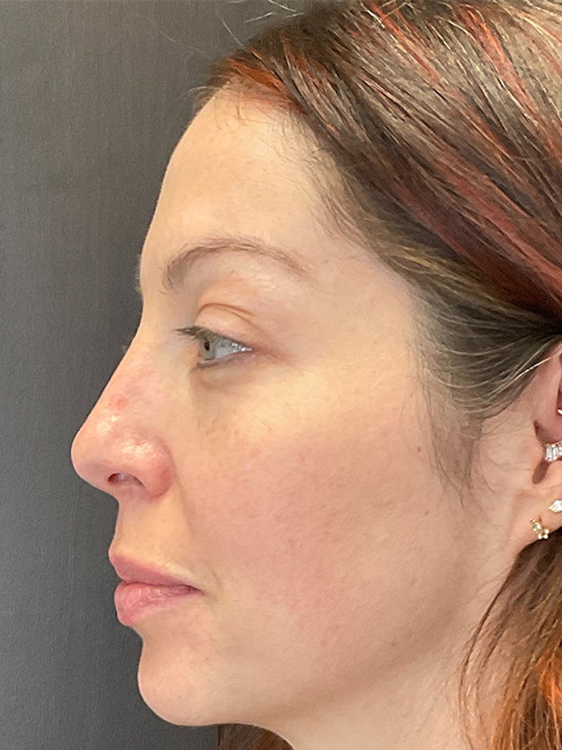 Full Face Filler Before & After Gallery - Patient 131838949 - Image 9