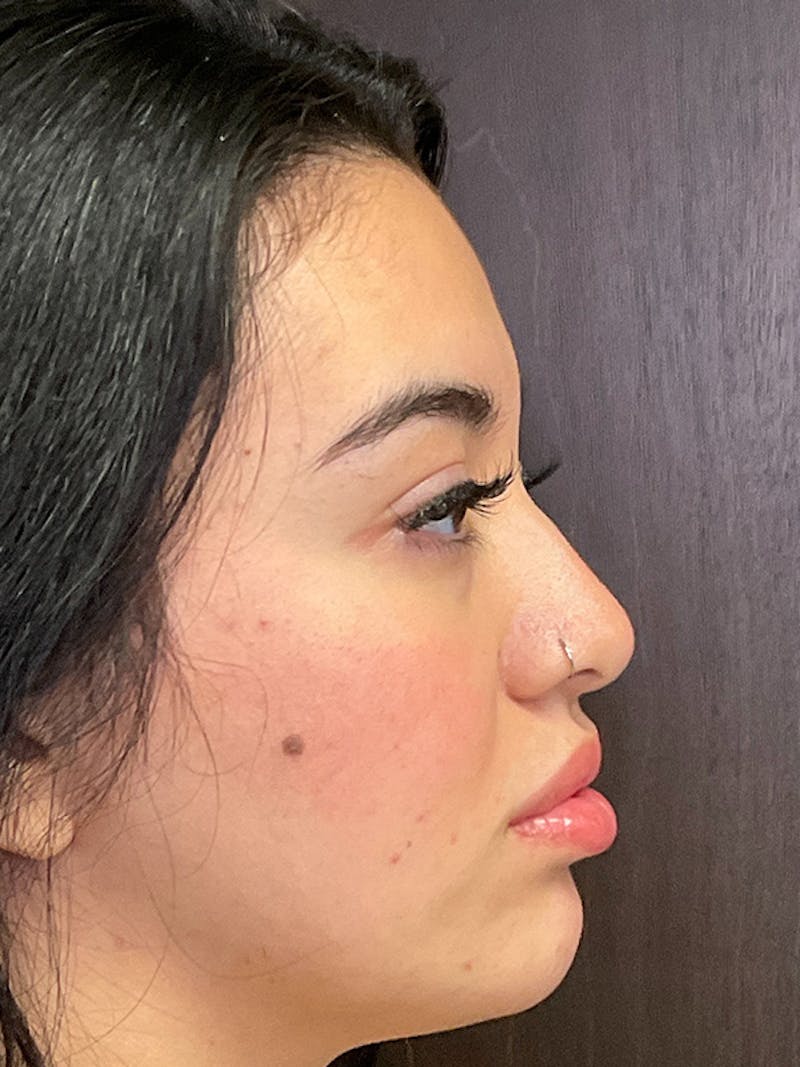 Full Face Filler Before & After Gallery - Patient 131838951 - Image 6