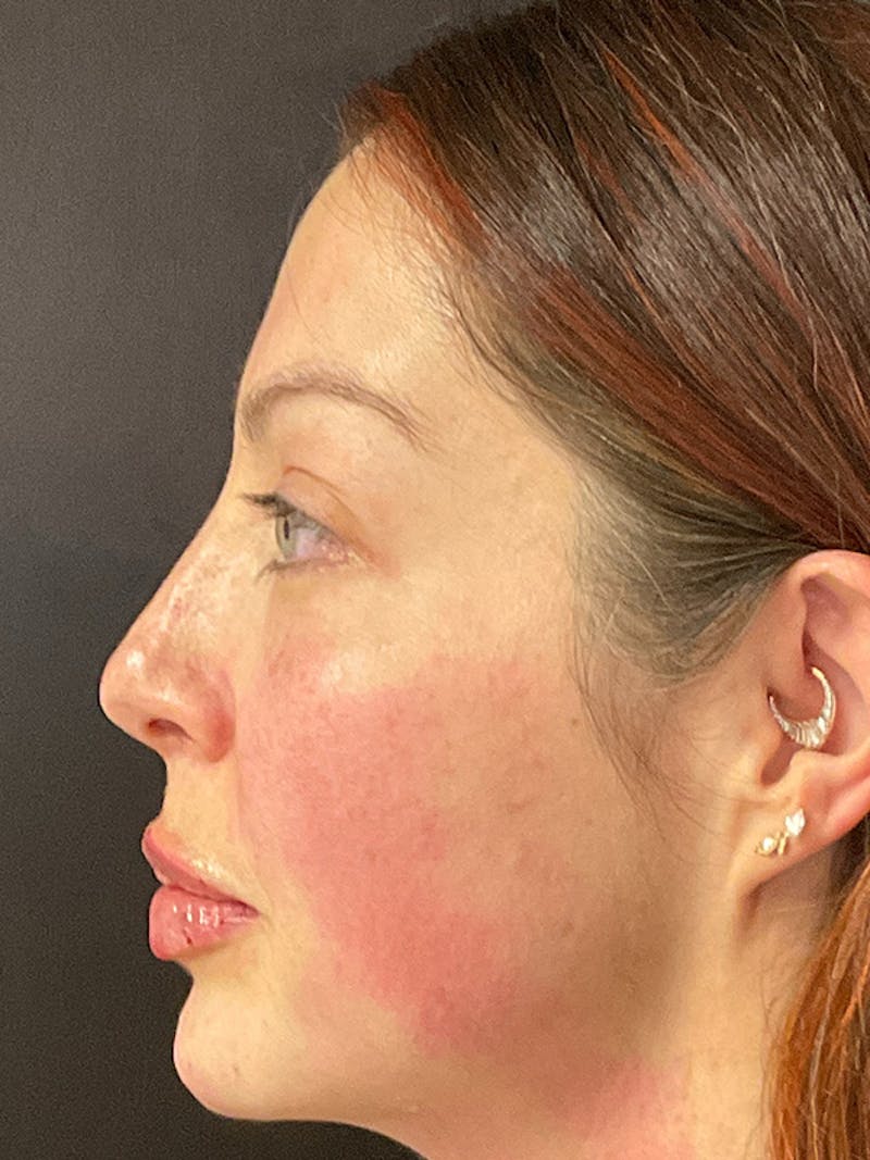 Full Face Filler Before & After Gallery - Patient 131838949 - Image 10