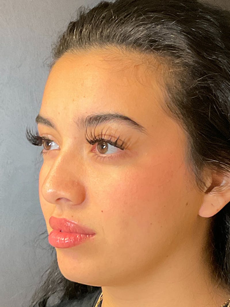 Full Face Filler Before & After Gallery - Patient 131838951 - Image 7