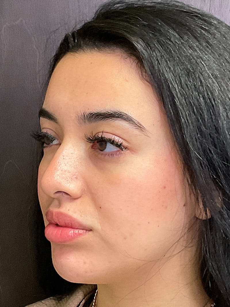 Full Face Filler Before & After Gallery - Patient 131838951 - Image 8