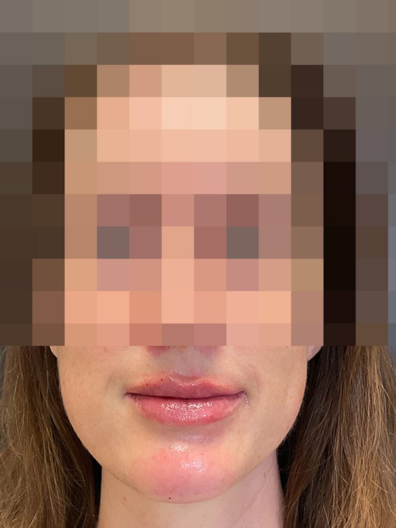 Full Face Filler Gallery - Patient 131838952 - Image 2