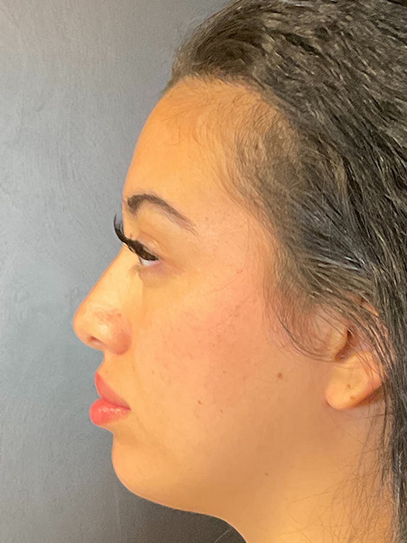 Full Face Filler Gallery - Patient 131838951 - Image 9
